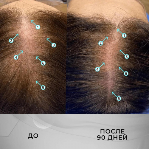 Лосьон для роста волос Nanodex 2%, 6 флаконов