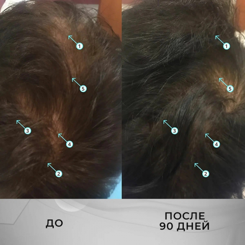 Лосьон для роста волос Nanodex 15% с азелаиновой кислотой, 1 флакон с мезороллером