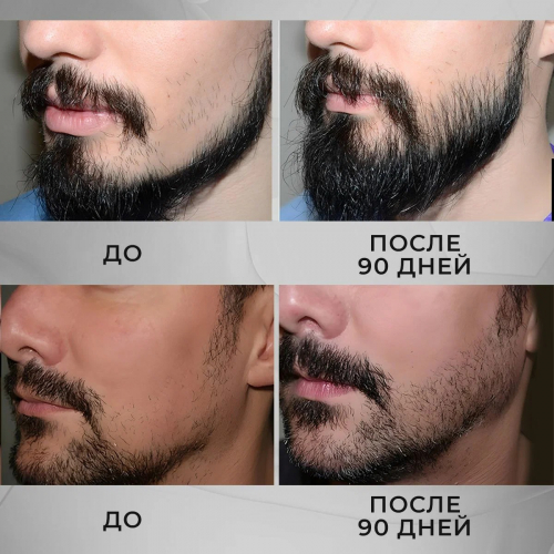 Лосьон для роста волос Nanodex 15% с азелаиновой кислотой, 1 флакон с мезороллером